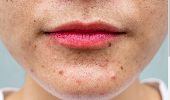 The Origin and Treatment of Acne